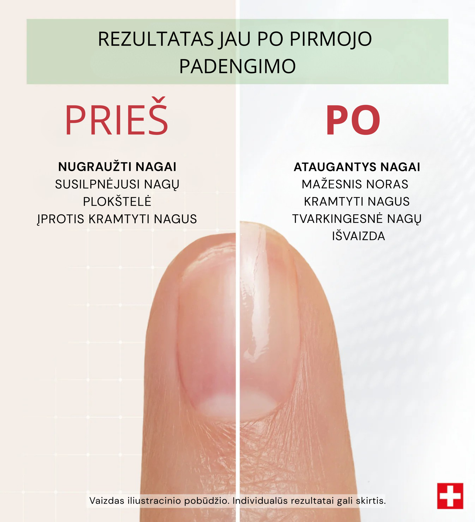 Nagų kramtymo korekcija su PODERM Bitter Nail Polish – prieš ir po