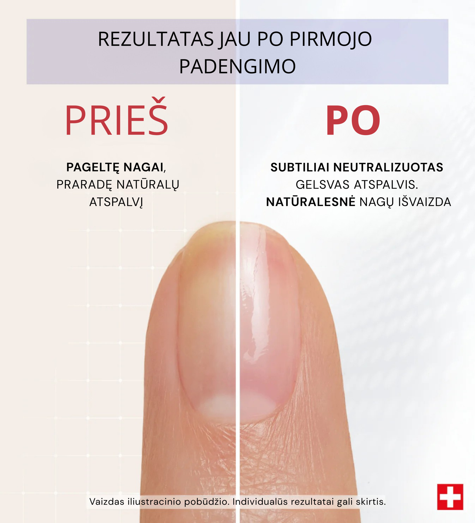 Pageltusių nagų korekcija su PODERM Yellow Neutralizer Lemon – prieš ir po